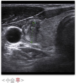갑상선고주파 수술후 초음파 사진
