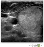 갑상선고주파 수술전 초음파 사진